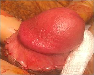 Conventional circumcision clip 1