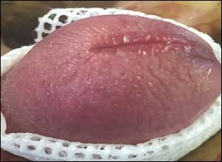 Conventional circumcision clip 2